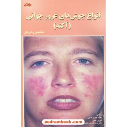انواع جوش های غرور جوانی ( آکنه ) / علوی